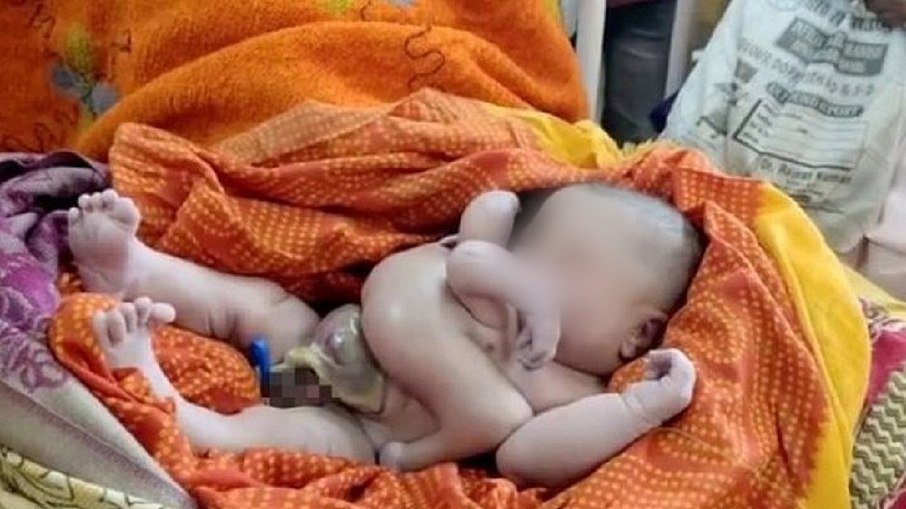 Bebê nasce com quatro braços e quatro pernas na Índia (Reprodução)