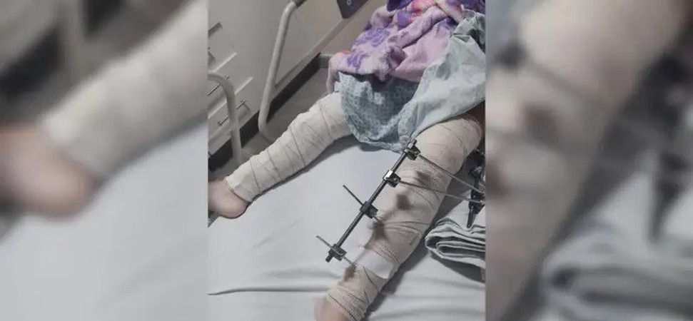 cirurgia perna errada de menina
