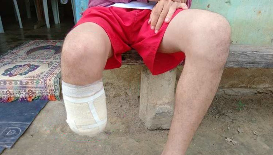 Homem é condenado após amputar o pé para receber seguro de R$ 1,5 milhão Homem e condenado apos amputar o pe para receber seguro