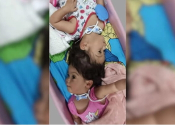 Gêmeas siamesas unidas pela cabeça morrem após cirurgia de separação