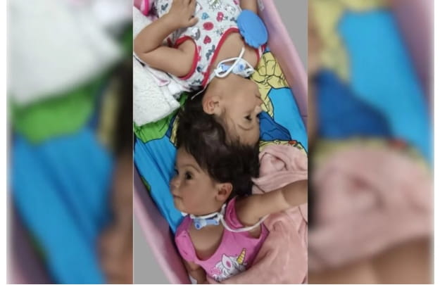 Gêmeas siamesas unidas pela cabeça morrem após cirurgia de separação Reprodução/ Redes Sociais