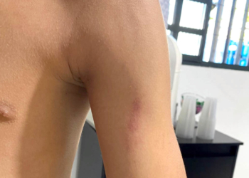 aluno com hematoma