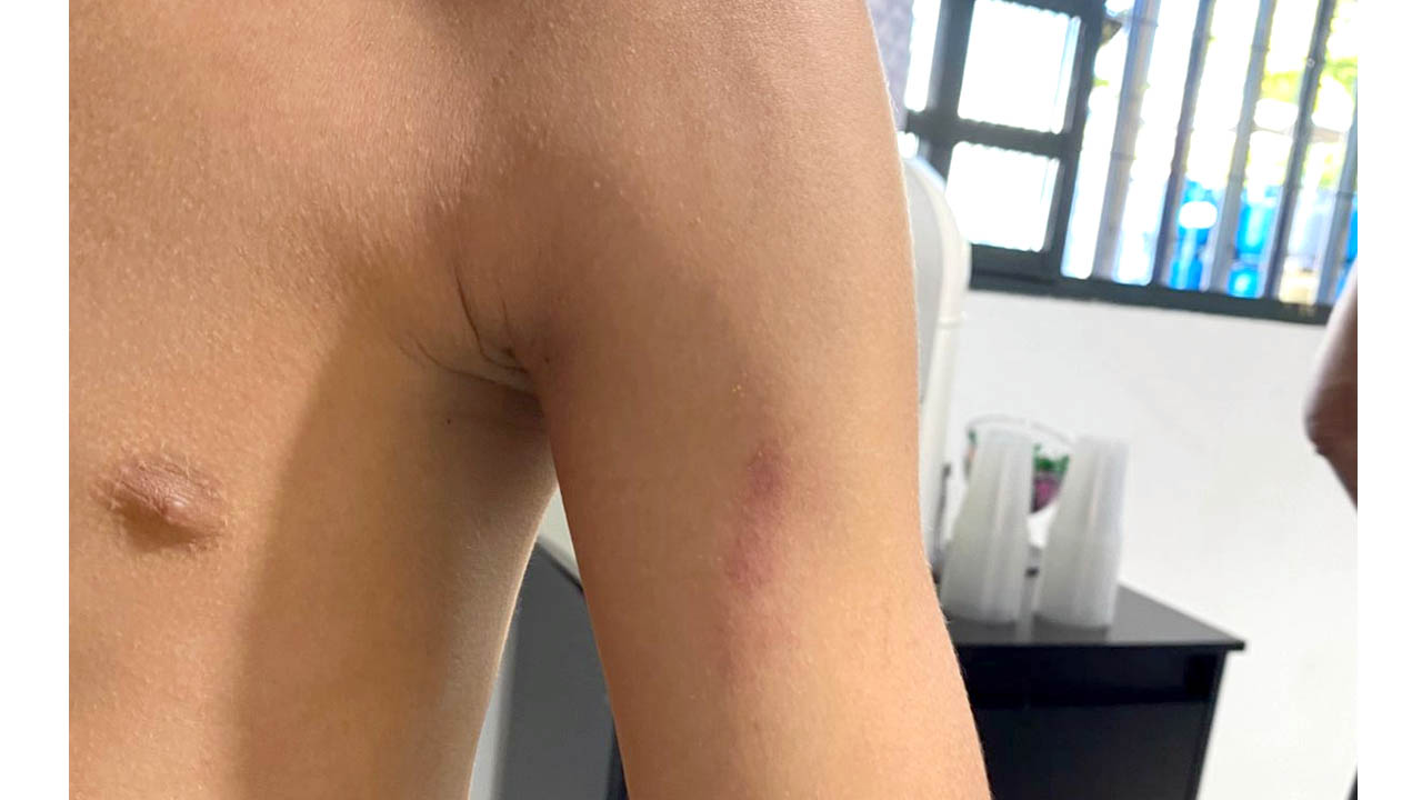 aluno com hematoma