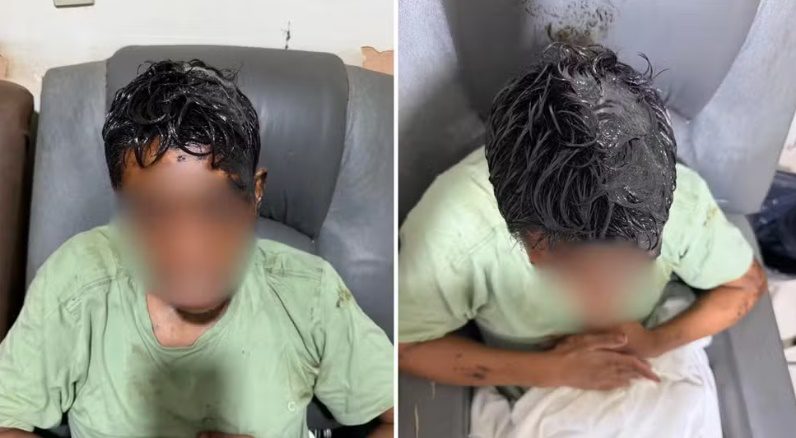 Jovem com deficiência tem corpo coberto por óleo diesel e precisa raspar cabelo Um homem de 28 anos com deficiência intelectual grave precisou ter o cabelo raspado após voltar para casa com o corpo e a cabeça cobertos por óleo diesel queimado, no sábado (24), em Nova Granada, no interior de São Paulo. O produto ficou impregnado nos cabelos e na pele, dificultando a higienização. O jovem foi levado à Santa Casa do município, recebeu atendimento médico e teve alta na manhã de domingo (25).O caso ocorreu depois que o morador saiu de casa para ir a um pequeno mercado próximo à residência onde vive com os avós maternos. A família não sabe explicar como ele foi coberto pela substância nem em que circunstâncias o episódio aconteceu.**Avó relata desespero ao encontrar o neto**Em entrevista ao g1, a avó materna do jovem, Laudiceia Lisboa da Silva, de 73 anos, contou que ficou desesperada ao ver o estado do neto quando ele voltou para casa.Segundo ela, a quantidade de óleo dificultou até mesmo a tentativa de dar banho no rapaz. As roupas, as meias e os sapatos precisaram ser descartados devido à contaminação pelo produto.“Teve que tirar, tava muito grudado o óleo na cabeça dele. Só dava para ver os dentes e o branco do olho. A roupa, meia, sapato, tive que jogar tudo fora. Fui dar banho nele e não conseguia. Não sei por que aconteceu essa maldade com ele”, relatou a idosa.Diante da dificuldade para remover o óleo dos cabelos e do couro cabeludo, foi necessário raspar a cabeça do jovem.**Jovem precisa de acompanhamento médico**De acordo com a avó, o neto apresenta limitações motoras e dificuldades de fala desde os dez meses de idade, quando teve febre alta e sofreu duas convulsões. Desde então, ele necessita de acompanhamento neurológico e faz uso de medicamentos.Após o episódio, o jovem foi levado à Santa Casa de Nova Granada, onde recebeu atendimento para a higienização da pele e a retirada do produto químico. Ele teve alta médica na manhã de domingo.**Polícia apura as circunstâncias do caso**A Polícia Militar foi acionada e encontrou o jovem no pronto atendimento do município, acompanhado pelo avô. Segundo as informações divulgadas, os policiais não identificaram sinais aparentes de agressão física, como hematomas ou escoriações.Até a última atualização das informações, a família não havia conseguido esclarecer o que aconteceu durante o período em que o rapaz esteve fora de casa. Também não havia suspeitos identificados.Procurada pela TV TEM, a Polícia Civil informou que aguardava o registro formal do boletim de ocorrência pelos familiares para dar início às diligências.As circunstâncias do episódio ainda precisam ser esclarecidas. Não há confirmação sobre como o óleo diesel atingiu o corpo do jovem nem se houve uma ação intencional. A investigação deverá buscar informações que permitam determinar o que aconteceu.